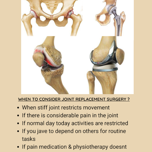 Joints Replacement Surgery