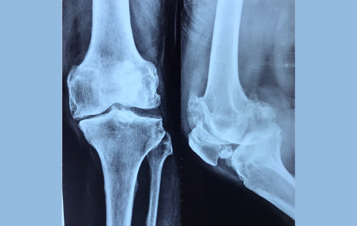 Total-Knee-Replacement-Xray