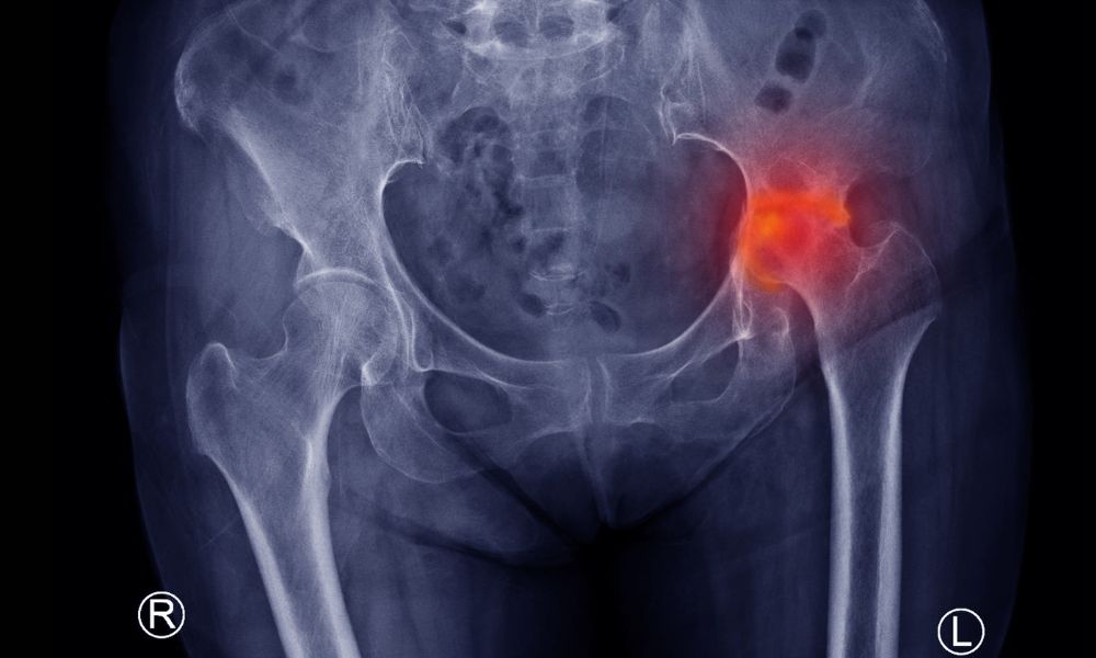 X ray of hip bones of avascular necrosis