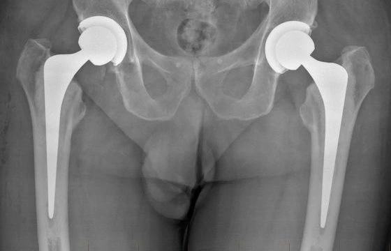 Total Hip Replacement