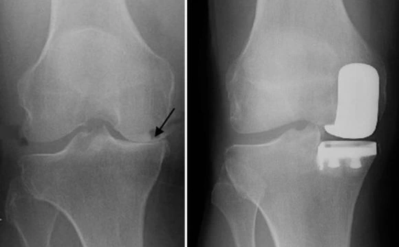 Partial Knee Replacement