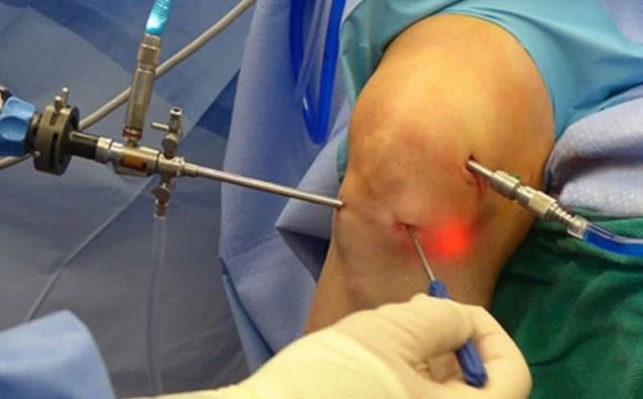 Surgeon performing knee arthroscopy using a minimally invasive procedure