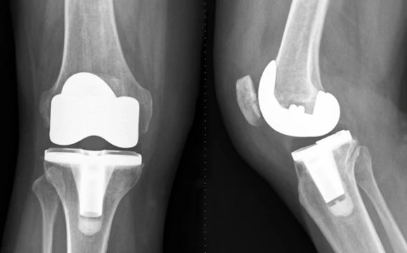 Total Knee Replacement