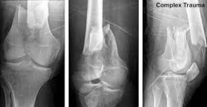 X-ray image of a broken knee showing a visible fracture in the bone